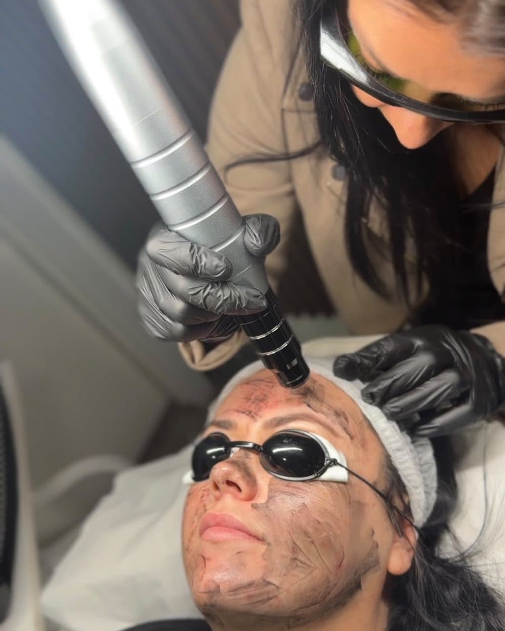 Carbon peel facial in progress