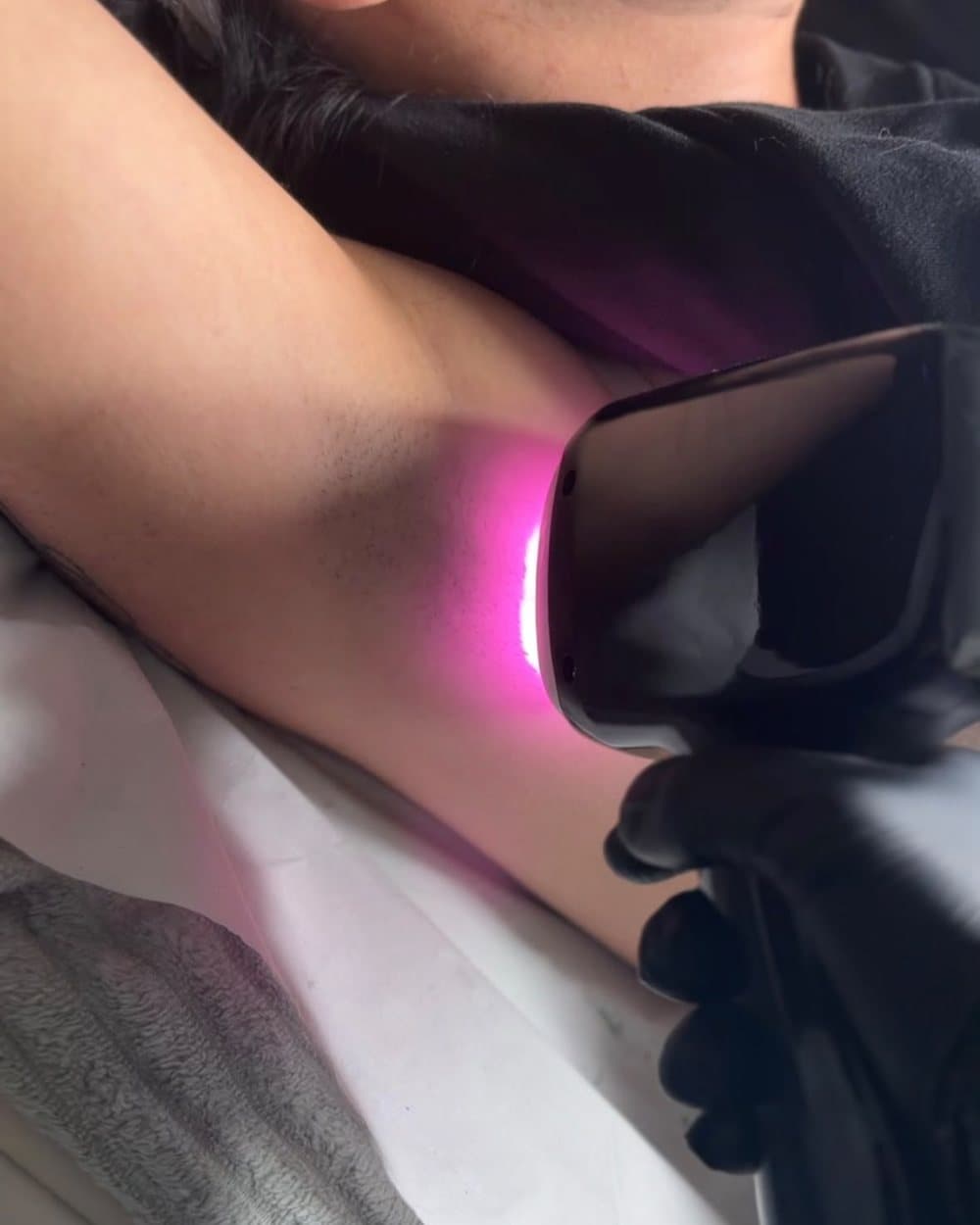Laser hair removal, underarm