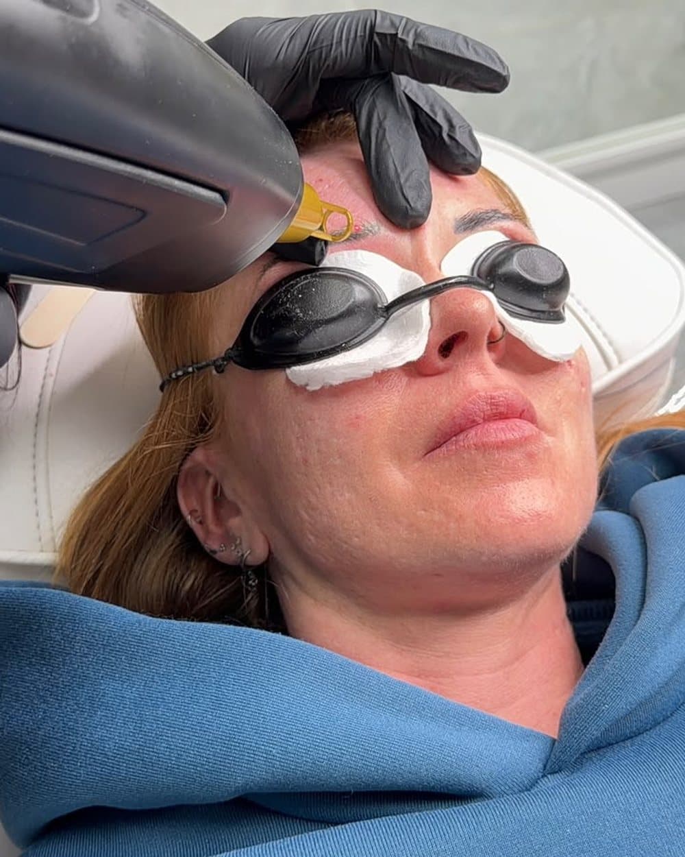 Laser removal of permanent makeup