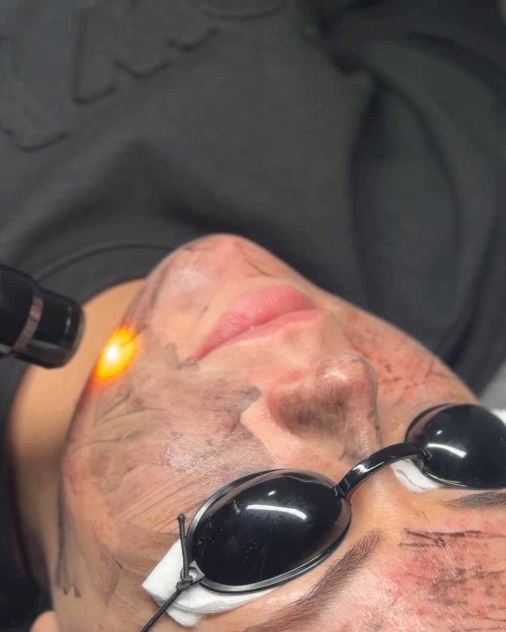 Laser tattoo removal on the face